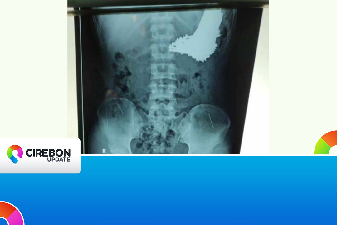 Gambar Rontgen organ pria di Indramayu yang dipenuhi batang paku